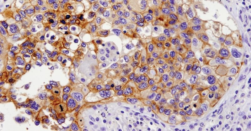 Immunohistochemical analysis of paraffin-embedded human lung carcinoma using PD-L1 (E1L3N®) XP® Rabbit mAb #13684.