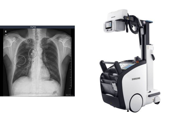 VUNO Med®-Chest X-ray™ & GM85